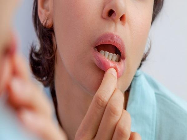 Mouth Ulcers home remedies