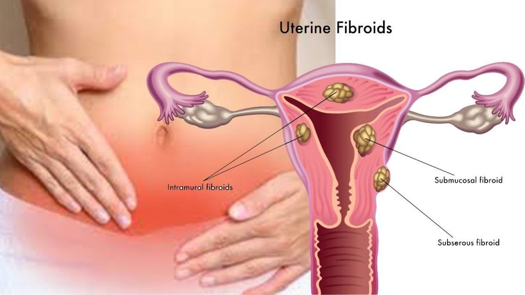 uterus Fibroids home remedies
