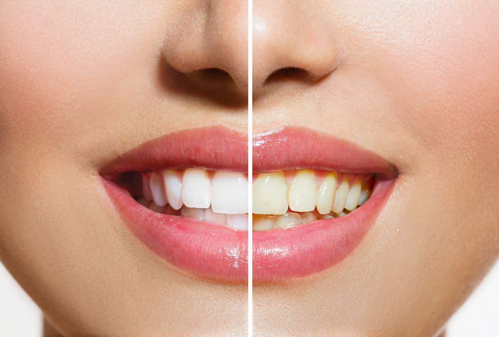 Yellowish teeth tips