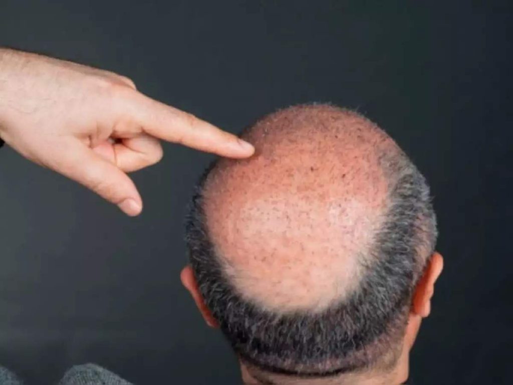 Baldness treatment tips