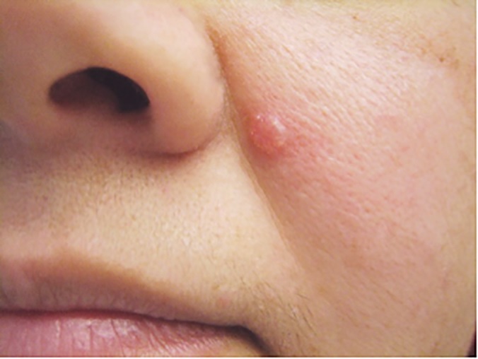 Basal Cell Carcinoma