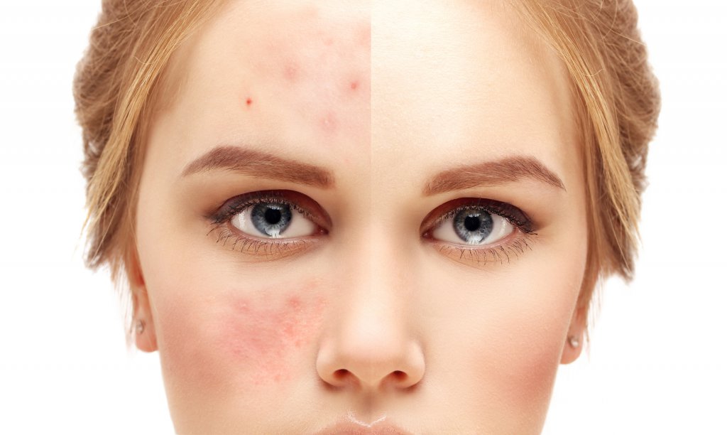Pimple Skin Care Tips
