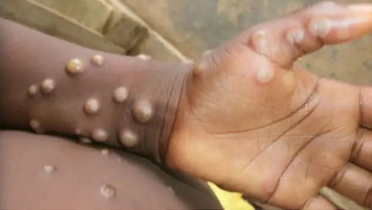 Monkeypox found in US