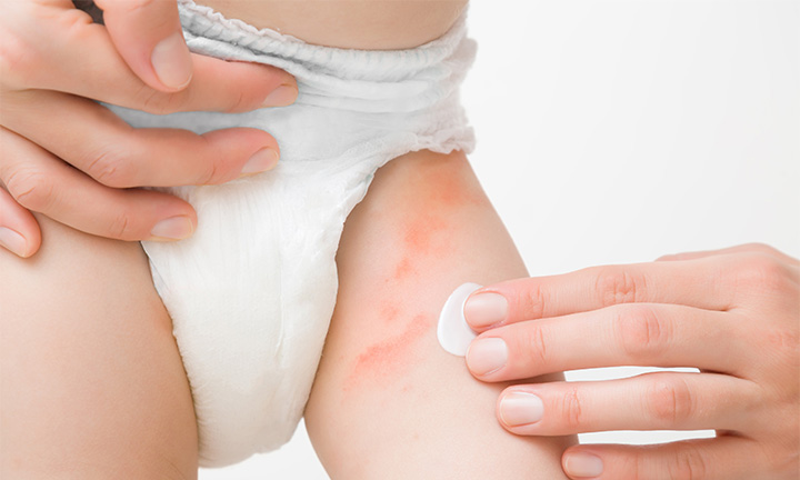 Diaper rashes care tips