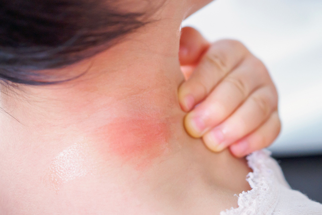 Baby skin rashes tips