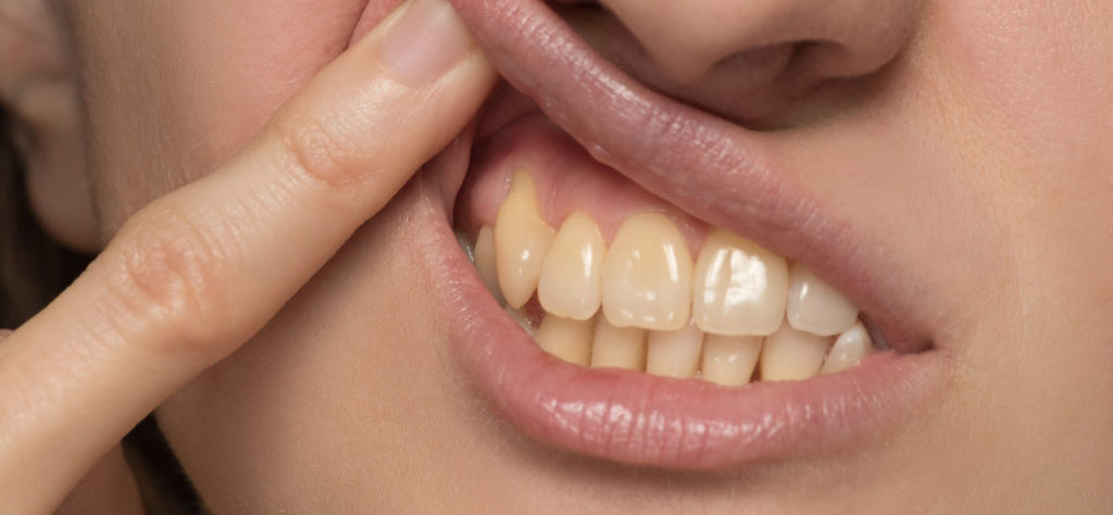 yellow teeth care tips